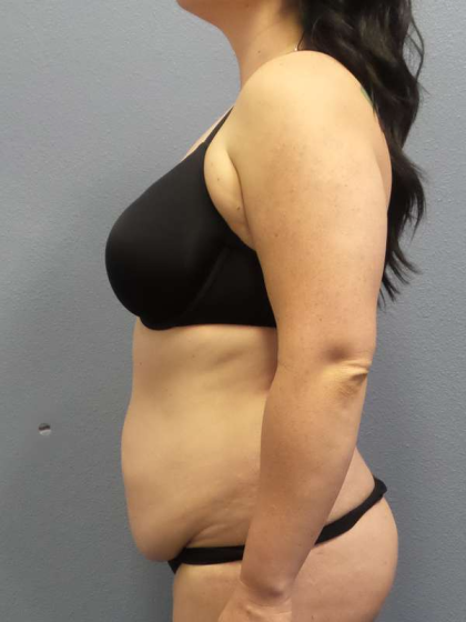 Abdominoplasty Before & After Patient #3550
