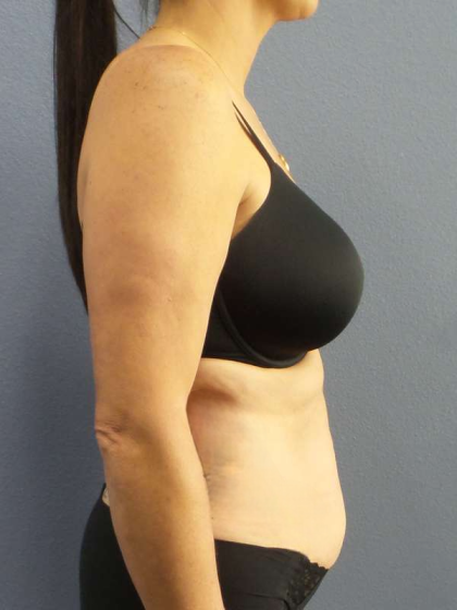 Abdominoplasty Before & After Patient #3471