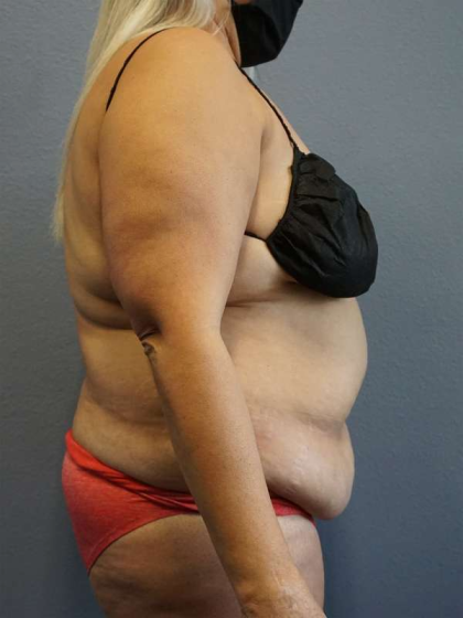 Abdominoplasty Before & After Patient #3437
