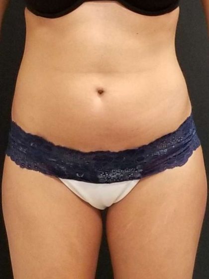 Trusculpt Before & After Patient #10254