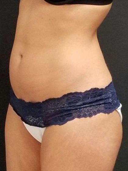 Trusculpt Before & After Patient #10254