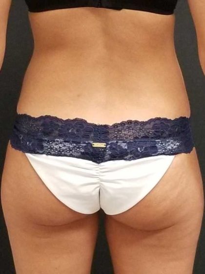 Trusculpt Before & After Patient #10254