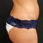 Trusculpt Before & After Patient #10254