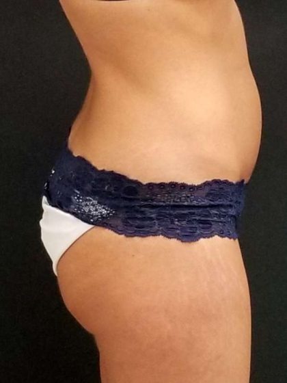 Trusculpt Before & After Patient #10254