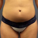 Trusculpt Before & After Patient #10254