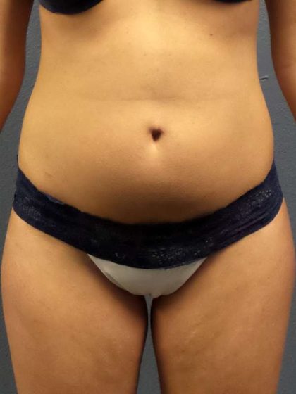 Trusculpt Before & After Patient #10254