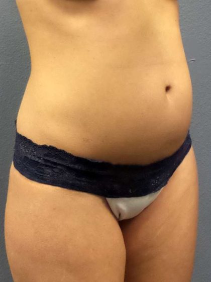 Trusculpt Before & After Patient #10254