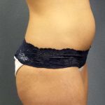 Trusculpt Before & After Patient #10254