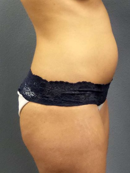 Trusculpt Before & After Patient #10254