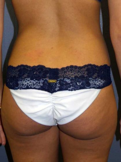 Trusculpt Before & After Patient #10254
