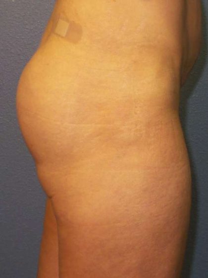 Brazilian Butt Lift Before & After Patient #4802