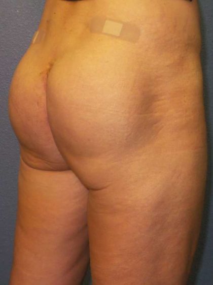 Brazilian Butt Lift Before & After Patient #4802