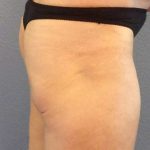 Brazilian Butt Lift Before & After Patient #4802