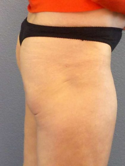 Brazilian Butt Lift Before & After Patient #4802