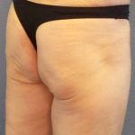 Brazilian Butt Lift Before & After Patient #4802