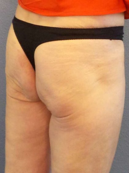 Brazilian Butt Lift Before & After Patient #4802