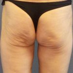 Brazilian Butt Lift Before & After Patient #4802
