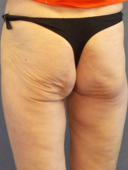 Brazilian Butt Lift Before & After Patient #4802