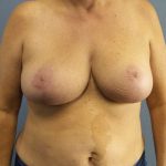 Breast Reduction Before & After Patient #7498