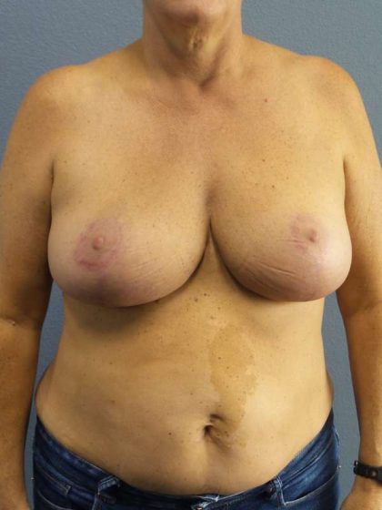 Breast Reduction Before & After Patient #7498