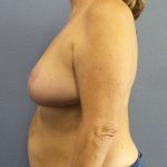 Breast Reduction Before & After Patient #7498