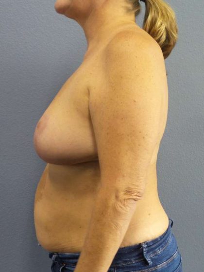 Breast Reduction Before & After Patient #7498