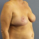 Breast Reduction Before & After Patient #7498