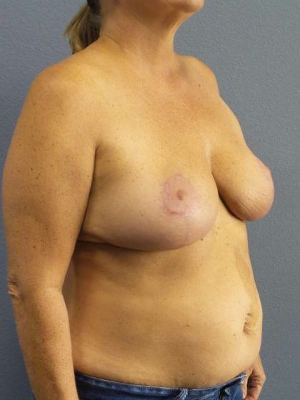 Breast Reduction Before & After Patient #7498