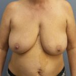 Breast Reduction Before & After Patient #7498