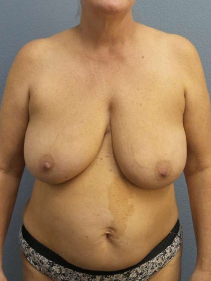 Breast Reduction Before & After Patient #7498