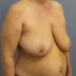 Breast Reduction Before & After Patient #7498