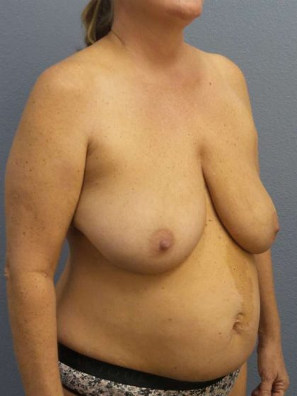 Breast Reduction Before & After Patient #7498