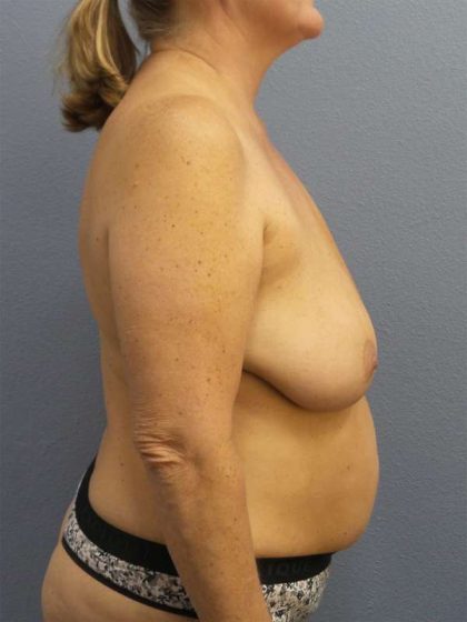 Breast Reduction Before & After Patient #7498