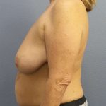 Breast Reduction Before & After Patient #7498