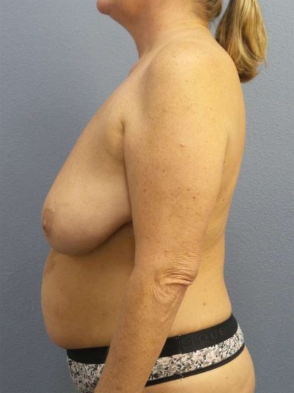 Breast Reduction Before & After Patient #7498