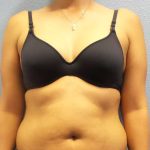 Liposuction Female Before & After Patient #8070