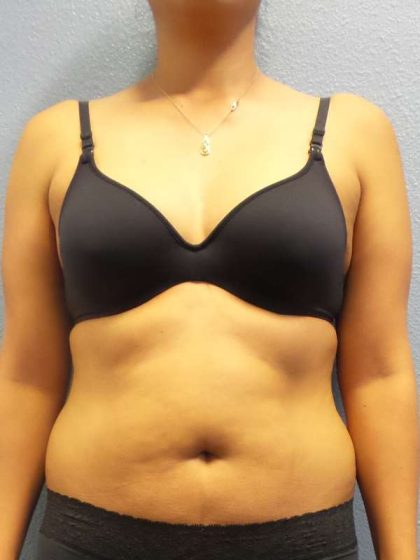Liposuction Female Before & After Patient #8070