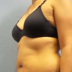 Liposuction Female Before & After Patient #8070
