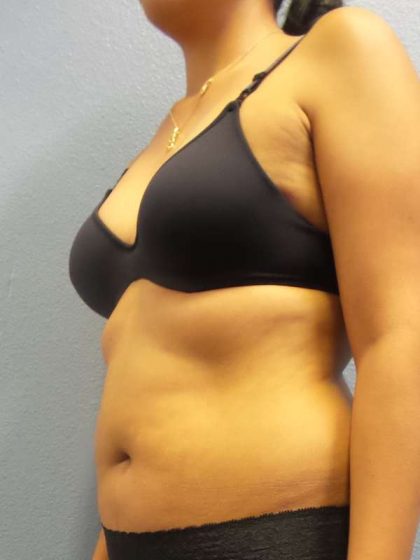 Liposuction Female Before & After Patient #8070