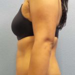 Liposuction Female Before & After Patient #8070