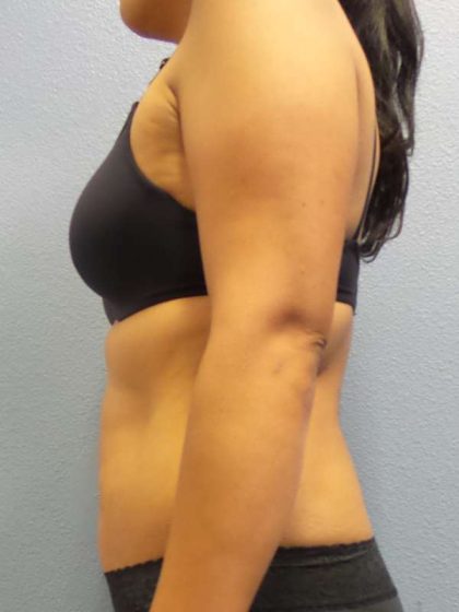 Liposuction Female Before & After Patient #8070