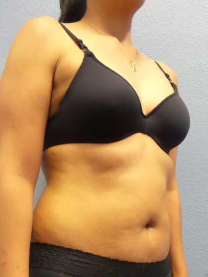 Liposuction Female Before & After Patient #8070