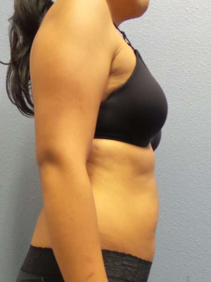 Liposuction Female Before & After Patient #8070