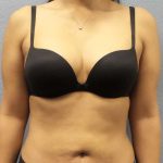 Liposuction Female Before & After Patient #8070