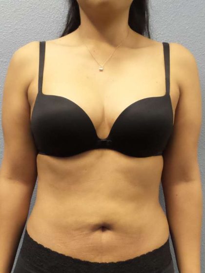 Liposuction Female Before & After Patient #8070