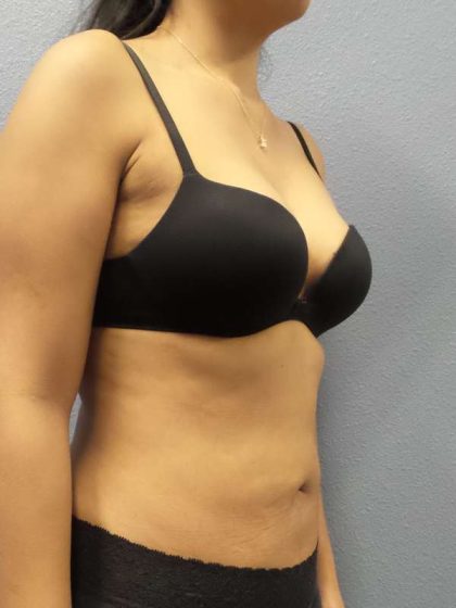Liposuction Female Before & After Patient #8070