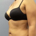Liposuction Female Before & After Patient #8070