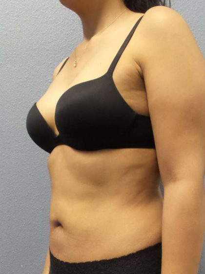 Liposuction Female Before & After Patient #8070