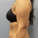Liposuction Female Before & After Patient #8070