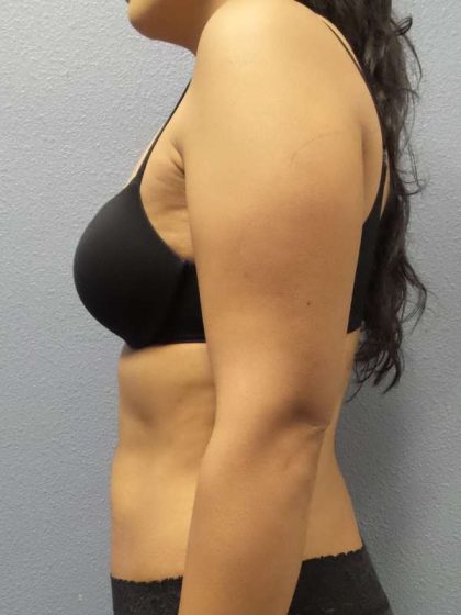 Liposuction Female Before & After Patient #8070